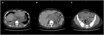 Case Report: Acute Pancreatitis Associated With Tacrolimus in Kidney Transplantation and a Review of the Literature